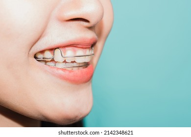 Close up white teeth of young Asian beautiful woman smiling wear silicone orthodontic retainers on teeth isolated on blue background, retaining tools after removable braces. Dental hygiene health - Shutterstock ID 2142348621