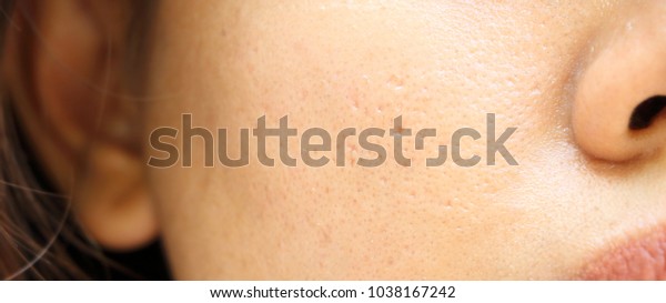 close up\
wide pores skin on oily face of asia\
woman
