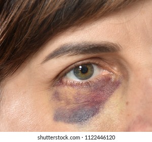 Close Up Of Woman With Bruise On Her Face.  Domestic Violence. 