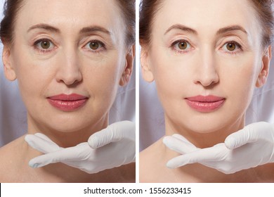 Close Up Woman Face Before After Lifting Injection. Middle Age Lady Before-after Wrinkled Skin, Eye Bags, Nasolabial Folds. Face Plastic Surgery, Collagen Anti Aging Cosmetic Procedure. Menopause