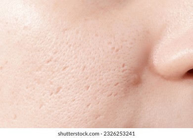 Close up of woman face has problems with skin on her face. Problems with acne and scar on the female skin.