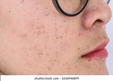 Close Up Of Woman Face Has Variety Problems On Her Skin (such As Acne, Pimple, Pores And Melasma Etc). Conceptual Of Natural Problem On Woman Skin.