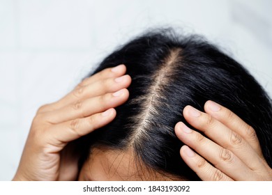 close up woman hair loss to head bald. caused by problem health care shampoo and beauty product concept.