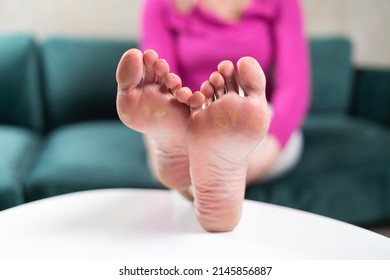 Close up of woman legs with callus on it. Feet with corn caused of heels. Need of pedicure 