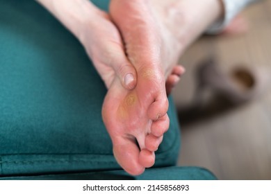 Close Up Of Woman Legs With Callus On It. Feet With Corn Caused Of Heels. Need Of Pedicure 