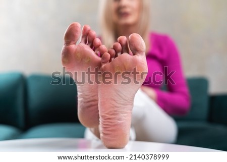 Close up of woman legs with callus on it. Feet with corn caused of heels. Need of pedicure 
