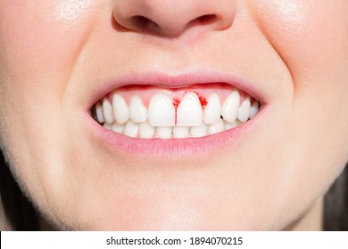 Close Up Of Woman Mouth With Bleeding Gums