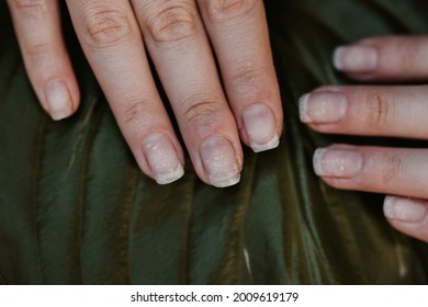 Close Up Woman Nails After Bad Manicure On The Background Of A Green Leaf.Overgrown Cuticle Fingernails And Tainted Nail Plate. Blurred. Grew Nails. Gel Nail Polish Fell Off.  Healthy And Care Concept