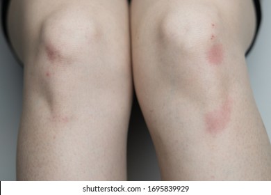 Close up of a woman sitting facing the camera, exposing the front of her knees with pale skin, freckles, redness, and bruising  - Shutterstock ID 1695839929