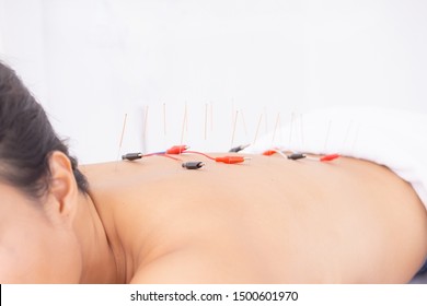 close up woman undergoing acupuncture treatment with electrical stimulation.