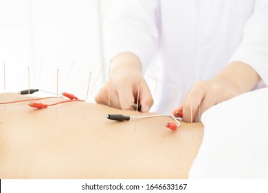 close up woman undergoing acupuncture treatment with electrical stimulation