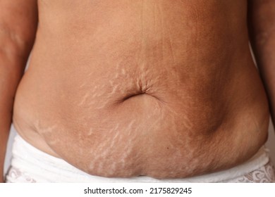 Close Up Of Woman's Belly With Stretch Mark Loose Lower Abdomen Skin She Fat After Pregnancy Baby Birth, Studio Isolated, Unhealthy Belly Overweight Excess Body Concept