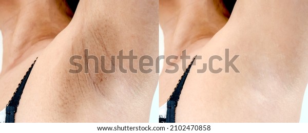 Close up Women armpit\
with problem black armpit. Dark and wrinkle armpit from deodorant\
allergic. Image compare before and after treatment for skin care\
and beauty concept