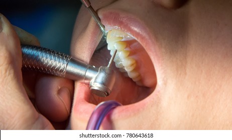 Scaling teeth