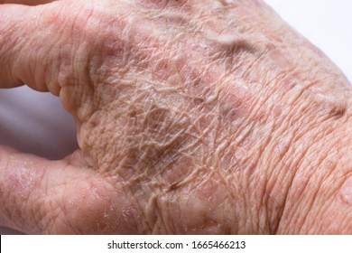 Close Up Of The Wrinkled Skin On The Hand Of An Older Man With Some Lesions Of Actinic Keratosis Or Sunspots