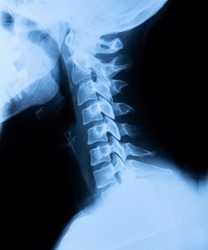 cervical vertebrae x-ray image by mri cervical spine for a medical ...