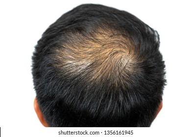 Close Up Young Asian Man Bold Head In The Middle With Black Hair Surround. Asian Man Hair Loss In The Middle. Isolated White Background.