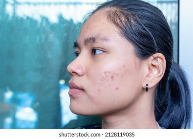Close up of young Asian woman worry about her face when she has problems with skin on her face. Problems with acne and scar on the female skin. Problem skincare and health concept. - Shutterstock ID 2128119035