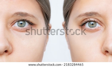 Close up of a young caucasian woman's face with drooping upper eyelid before and after blepharoplasty isolated on white background. Result of plastic surgery. Changing the shape, cut of the eyes