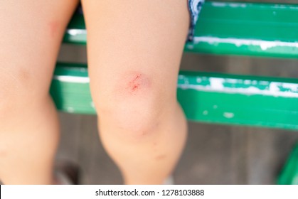 Swollen Knee Treatment Images, Stock Photos & Vectors | Shutterstock