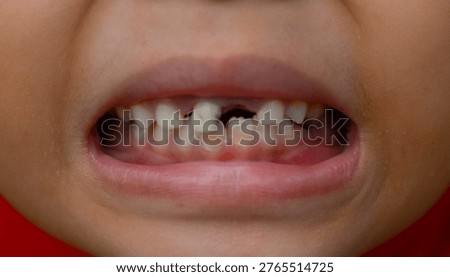 Close Up of Young Child’s Front Teeth with Severe Decay and Caries
