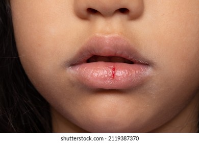 Close Up Young Girl Dry Lips With Crack And Visible Blood Medical Condition.