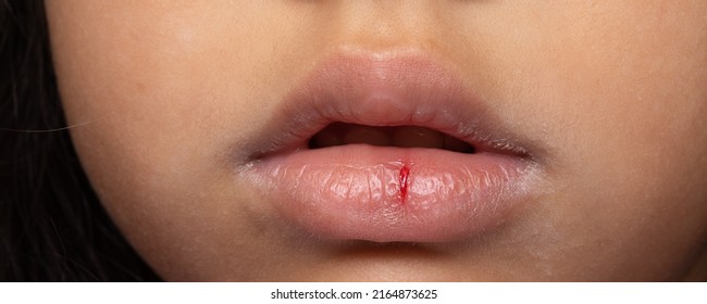 Close Up Young Girl Dry Lips With Crack And Visible Blood Medical Condition.