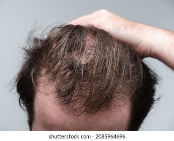 Close up of a young man holding his hair back showing clear signs of a receding hairline and hair loss. First stages of male pattern baldness with bald patches and thinning hair. - Powered by Shutterstock