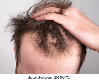 Close up of a young man holding his hair back showing clear signs of a receding hairline and hair loss. Concept showing the first stages of male pattern baldness with bald patches and thinning hair.