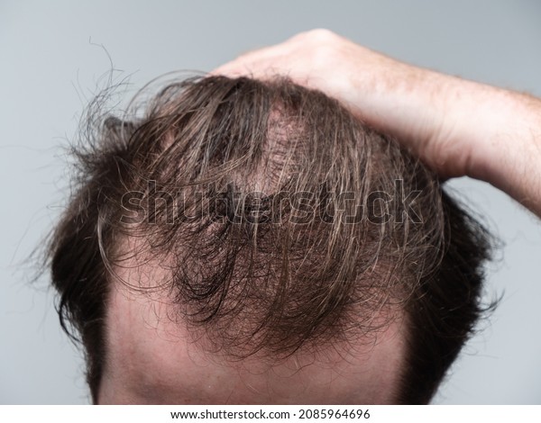 Close up of\
a young man holding his hair back showing clear signs of a receding\
hairline and hair loss. First stages of male pattern baldness with\
bald patches and thinning\
hair.