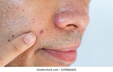 Close Up Of Young Man Pointing Acne Occur On His Skin. A Pimple Is A Small Inflammation Or Swelling Of The Skin That May Or May Not Be Filled With Pus.