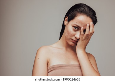 Close up of young woman hiding her acne skin with hand. Skin problems brings insecurity and low self esteem. - Shutterstock ID 1990024655