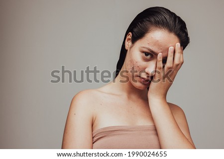 Close up of young woman hiding her acne skin with hand. Skin problems brings insecurity and low self esteem.