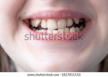 Close up of young woman's face with crooked teeth. Teeth before install braces. Teeth need ortodonti.