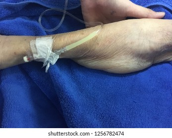 Closed Up Arm Edema From Intravenous Fluid Leaked.