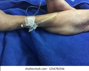 Closed Up Arm Edema From Intravenous Fluid Leaked.