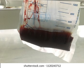 Closed Up Blood In Urine Or Hematuria.