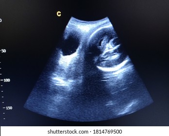 what is cephalic presentation in pregnancy scan