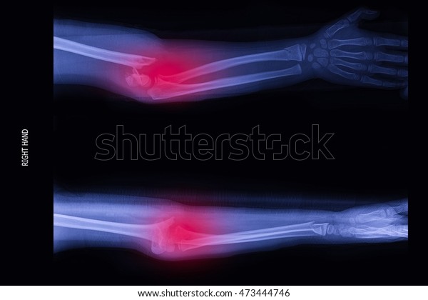 Closed Fracture Elbow Right Hand Stock Photo (Edit Now) 473444746