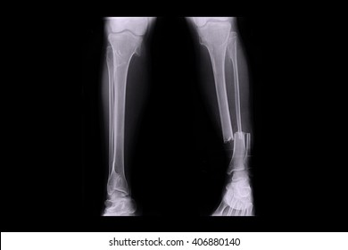 closed fracture left leg , ( Xray both leg ) 