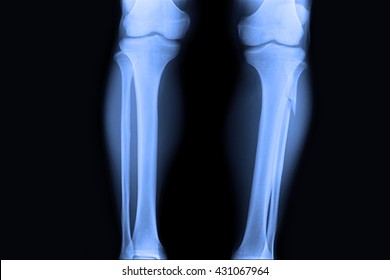 Closed Fracture Left Leg , ( Xray Both Leg )