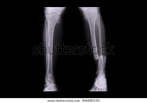 closed fracture\
left leg , ( Xray both leg )\
