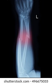 Closed Fracture Radius Ulna Left Hand Stock Photo 496675033 | Shutterstock