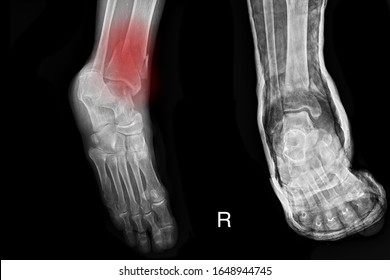 Closed Fracture Tibia Right Leg