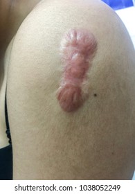 Closed Up Keloid Scare On Human.