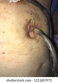 Closed Up Percutaneous Endoscopic Gastrostomy (P.E.G) Or Tube Feeding Patient Stomach.