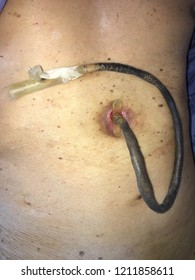 Closed Up Percutaneous Endoscopic Gastrostomy (P.E.G) Or Tube Feeding Patient Stomach.