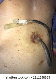 Closed Up Percutaneous Endoscopic Gastrostomy (P.E.G) Or Tube Feeding Patient Stomach.