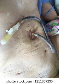 Closed Up Percutaneous Endoscopic Gastrostomy (P.E.G) Or Tube Feeding Patient Stomach.