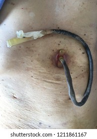 Closed Up Percutaneous Endoscopic Gastrostomy (P.E.G) Or Tube Feeding Patient Stomach.